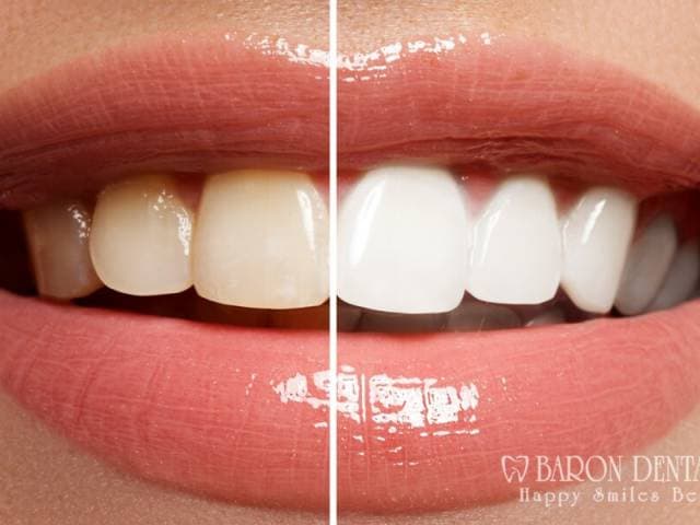 Bleaching | Bleichen