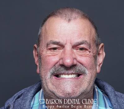 Baron Dental Patient 28