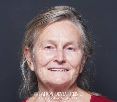 Baron Dental Patient 20