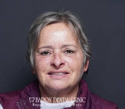 Baron Dental Patient 4