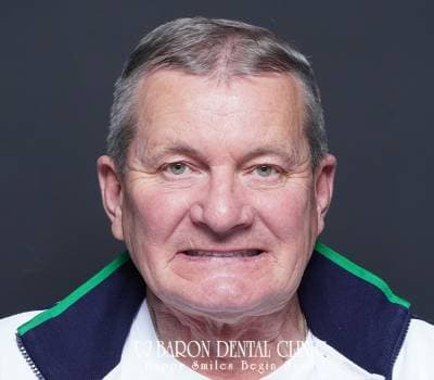 Baron Dental Patient 18