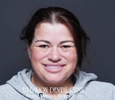 Baron Dental Patient 35