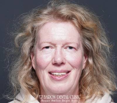 Baron Dental Patient 13