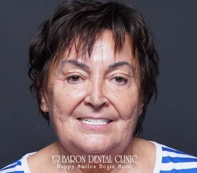 Baron Dental Patient 47