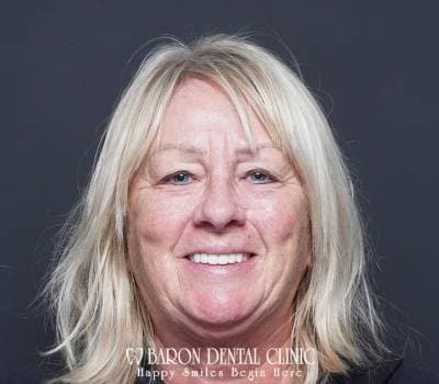 Baron Dental Patient 50