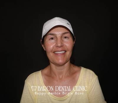 Baron Dental Patient 42