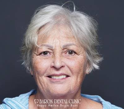 Baron Dental Patient 40