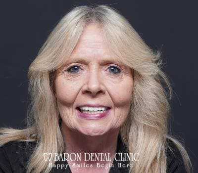 Baron Dental Patient 49