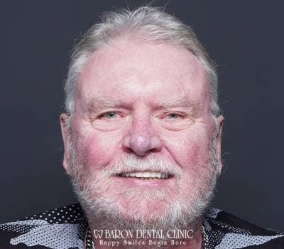 Baron Dental Patient 24